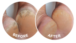 Dermal Therapy Heel Balm 50g
